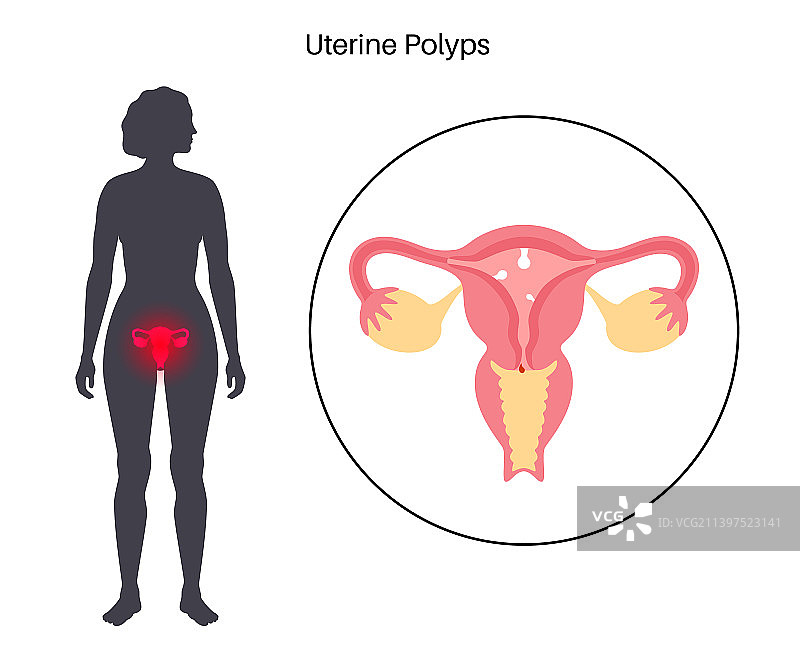 子宫息肉疾病图片素材