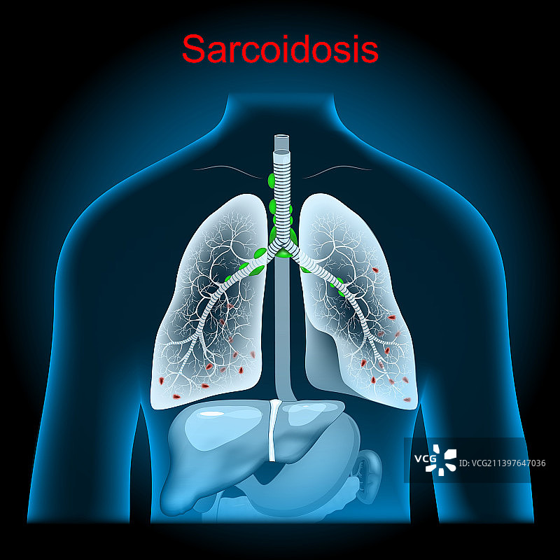 肺部结节病淋巴结肿大图片素材