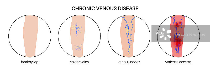 静脉曲张治疗图片素材