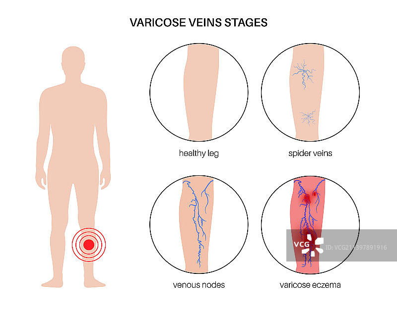 静脉曲张治疗图片素材