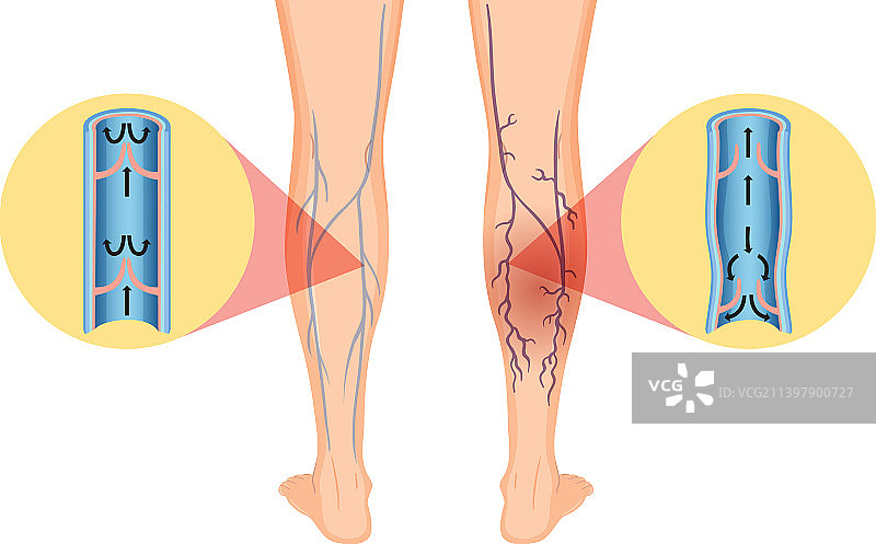 患有静脉曲张的人腿图片素材