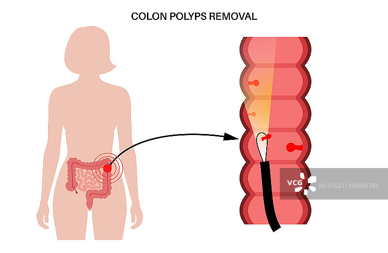 结肠息肉炎症图片素材