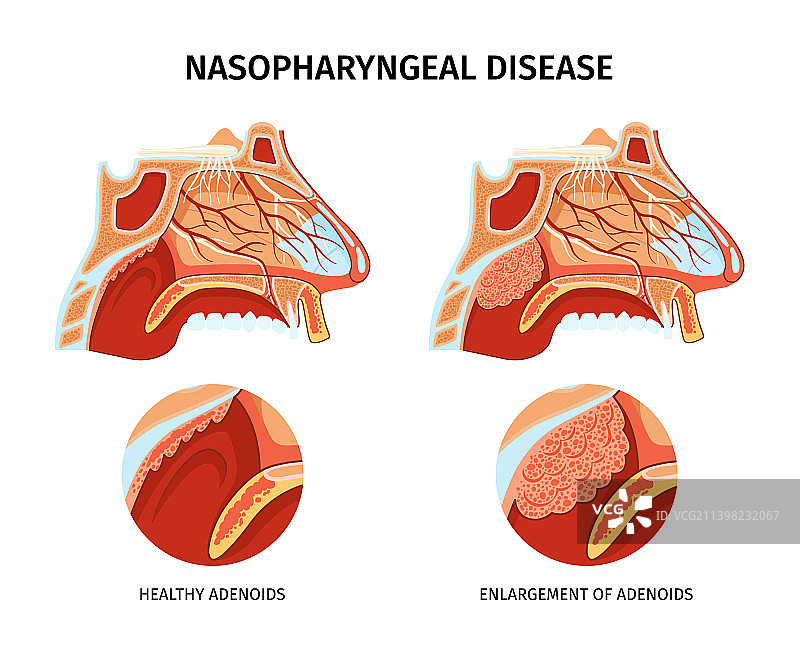 鼻咽疾病海报图片素材