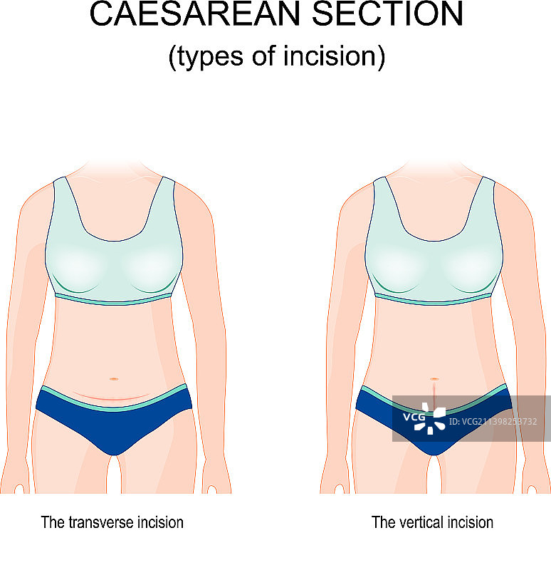 剖腹产切口类型图片素材