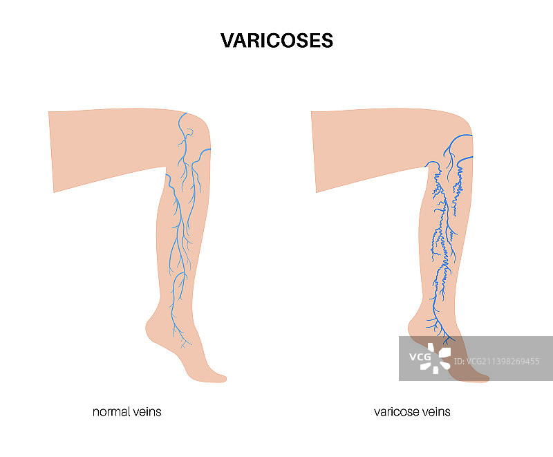 静脉曲张治疗图片素材
