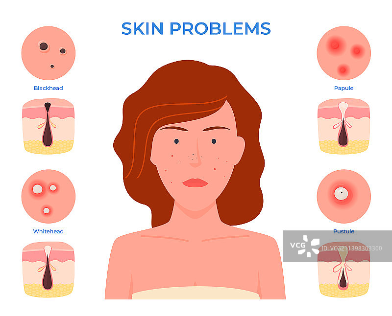 有粉刺皮肤问题的女子面部特写图片素材