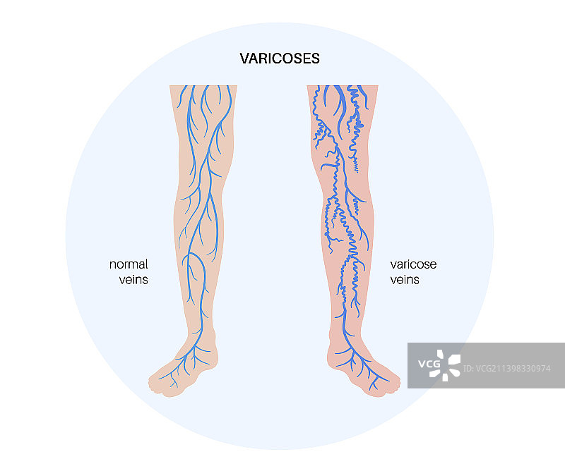 静脉曲张治疗图片素材