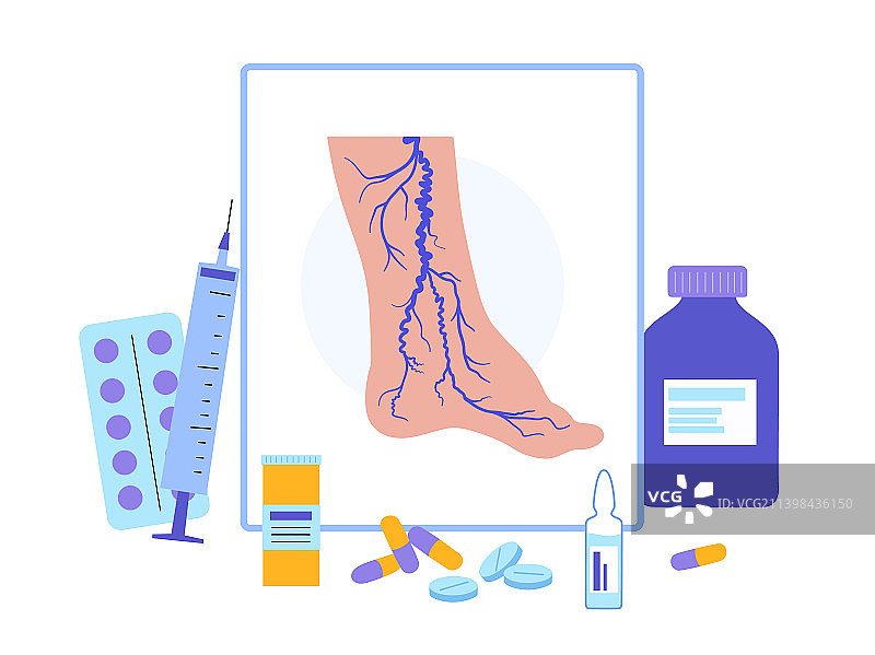 静脉曲张治疗图片素材