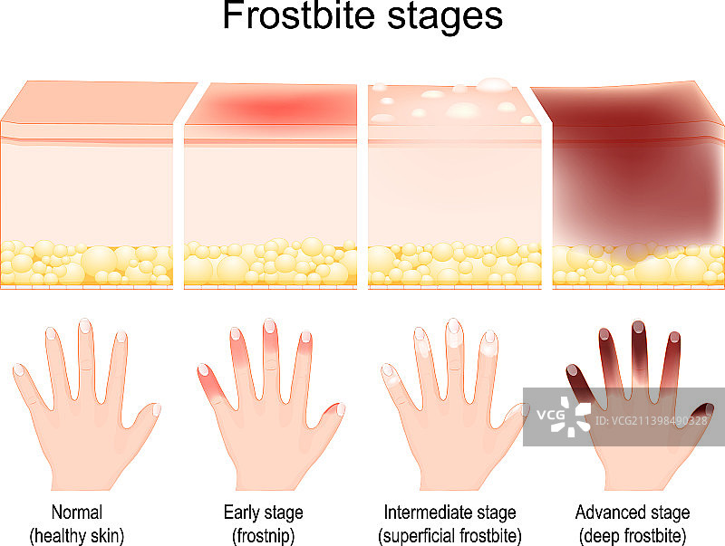 冻伤各阶段皮肤损伤图片素材
