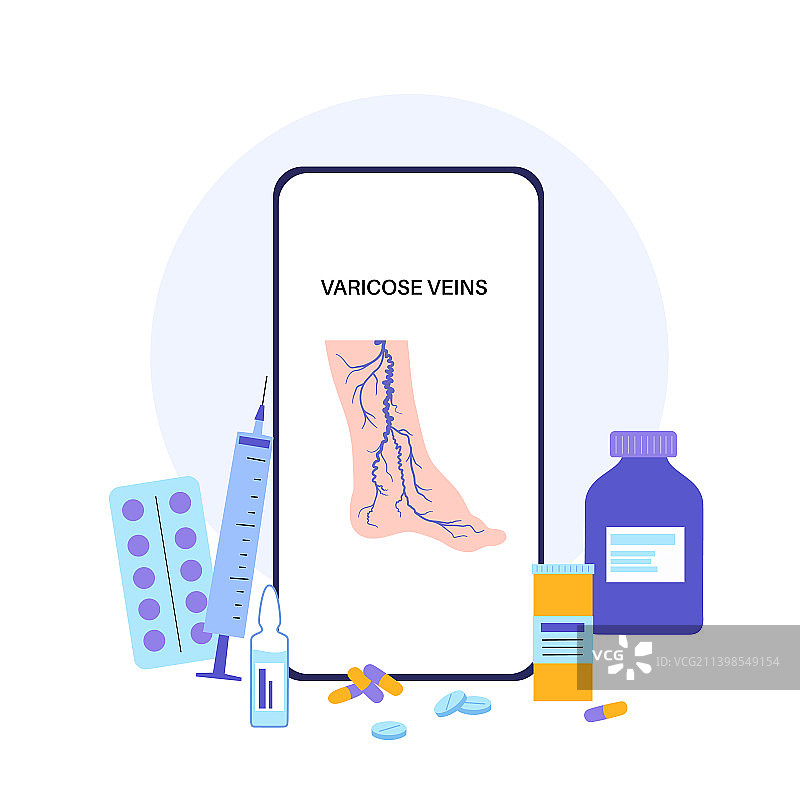 静脉曲张治疗图片素材