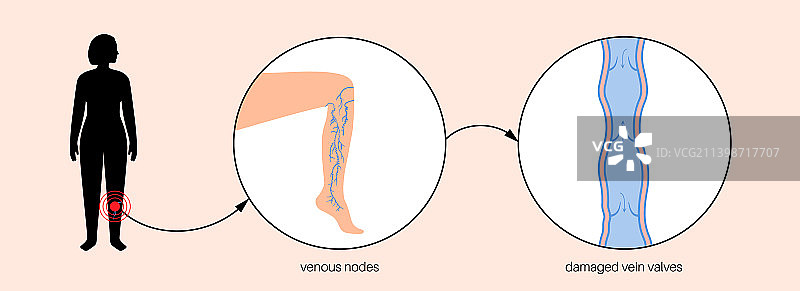静脉曲张治疗图片素材