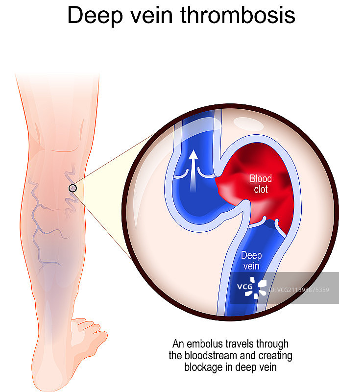 深静脉血栓特写血管图片素材