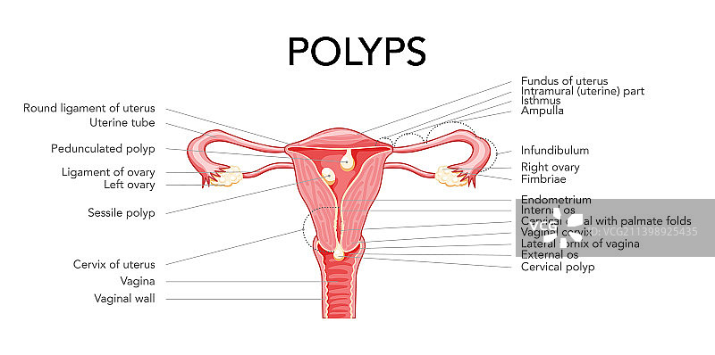 子宫息肉铭文图图片素材