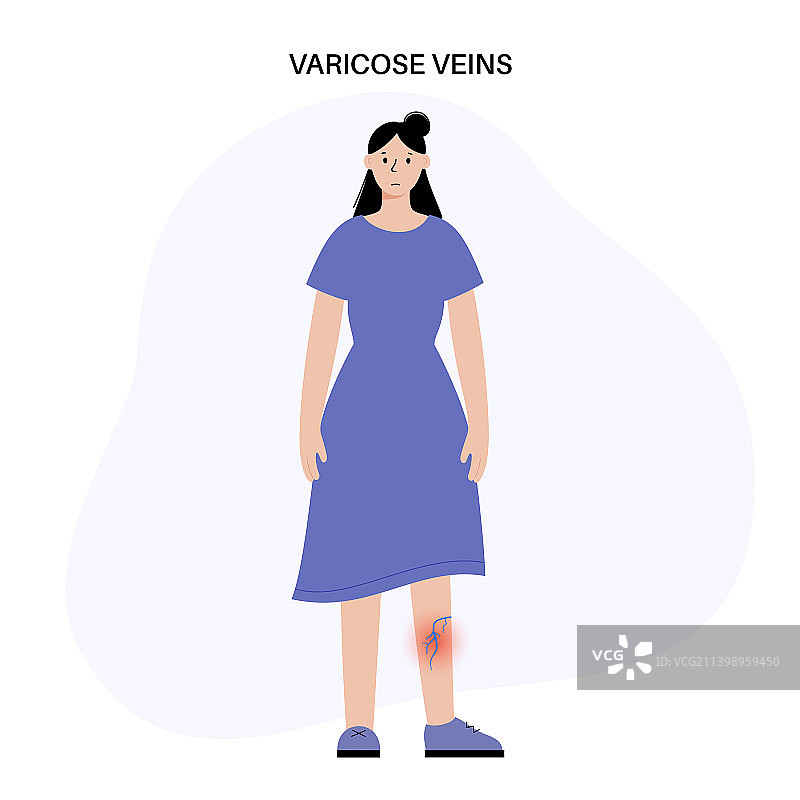 静脉曲张治疗图片素材