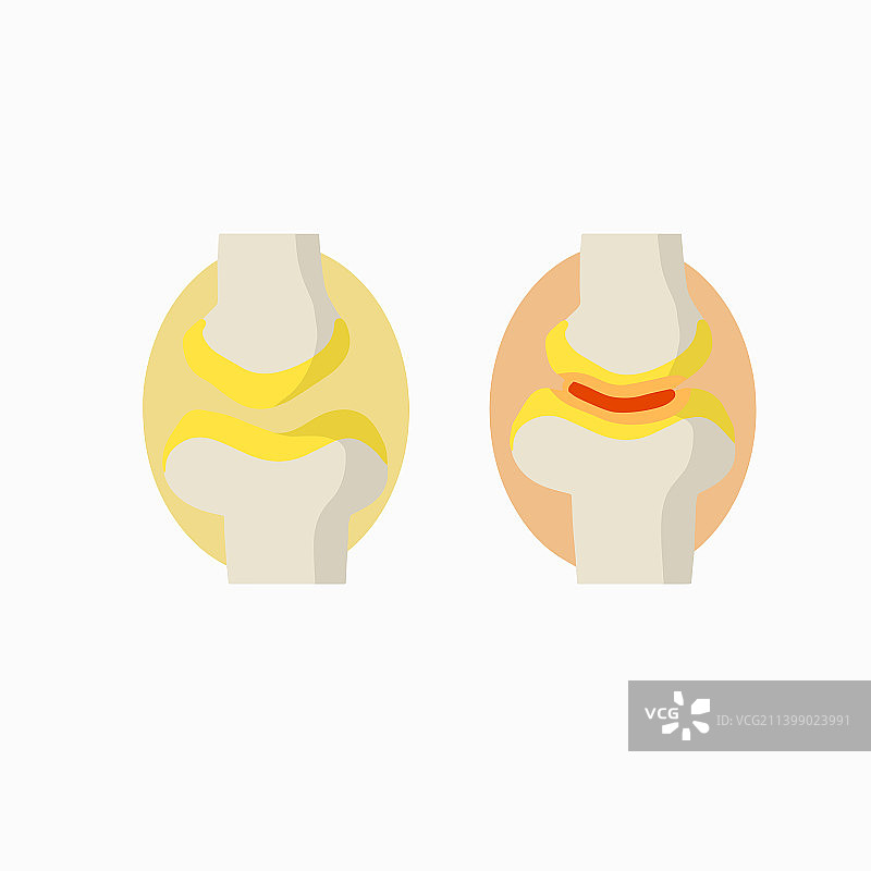关节炎关节疾病图片素材