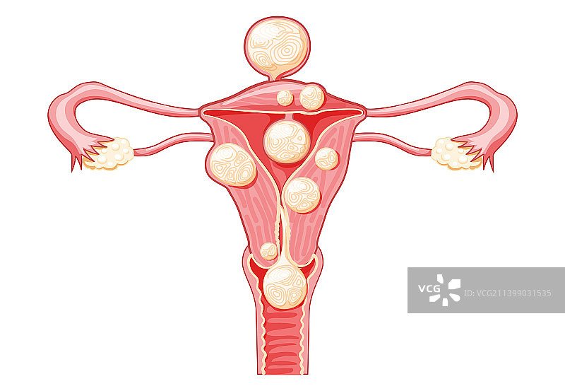 子宫肌瘤女性平滑肌瘤生殖图片素材