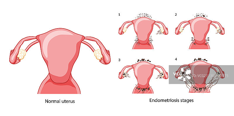 子宫内膜异位症分期图片素材