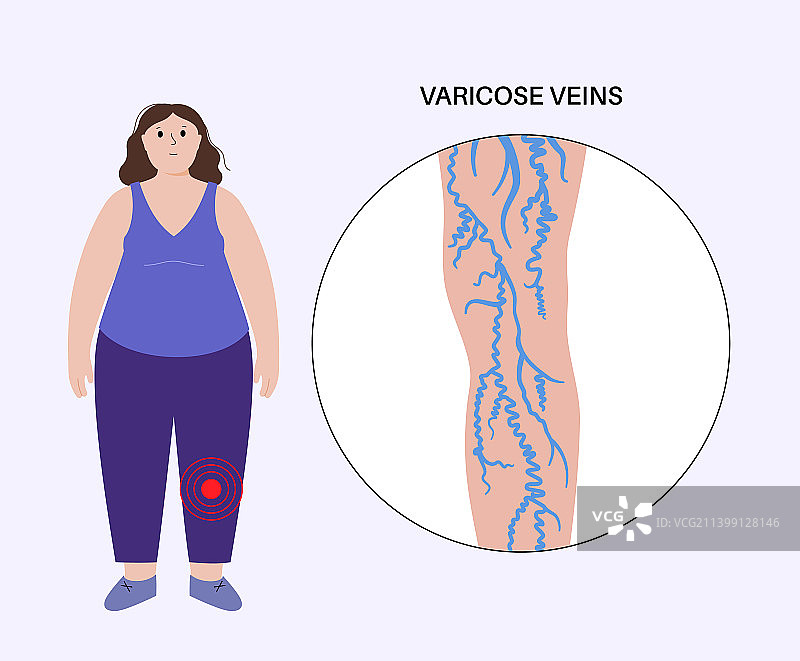 静脉曲张治疗图片素材