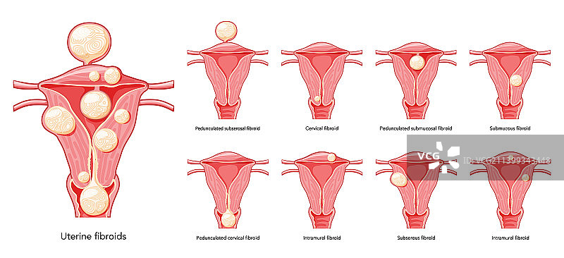 子宫肌瘤女性平滑肌瘤合集图片素材