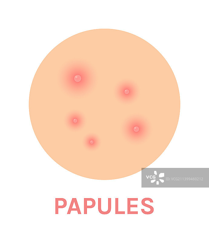 丘疹痤疮问题肌肤特写图片素材