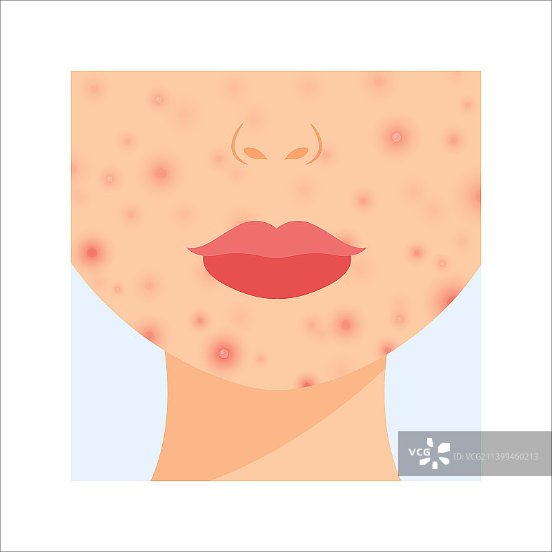 女性面部皮肤问题：下巴上的痤疮粉刺图片素材
