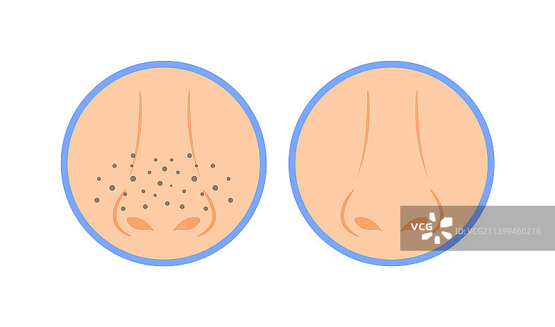 鼻子上的黑头图片素材