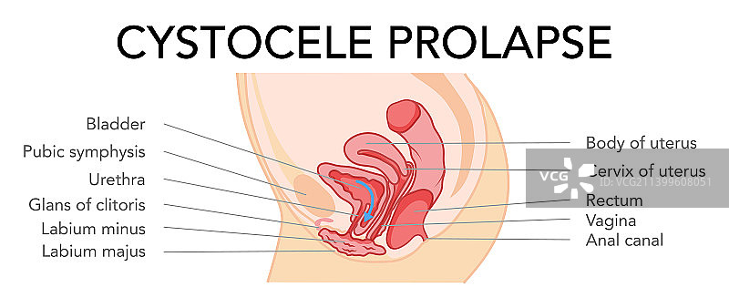 膀胱膨出女性生殖系统图片素材