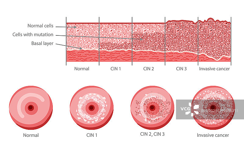 宫颈浸润癌上皮内瘤变图片素材