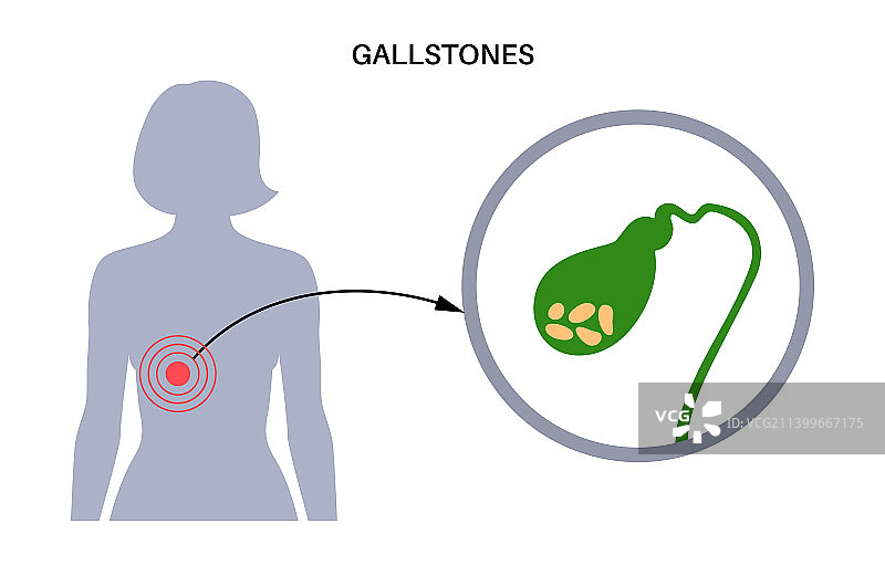 胆结石解剖图片素材