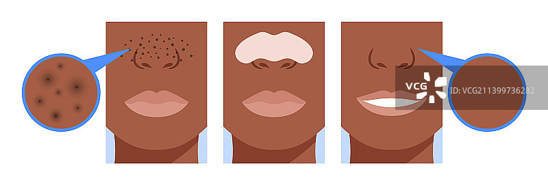 使用鼻贴前后的黑头对比图片素材