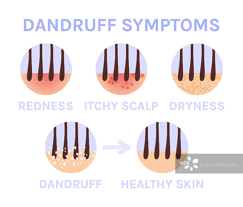 头皮屑和图标放大头发问题症状图片素材