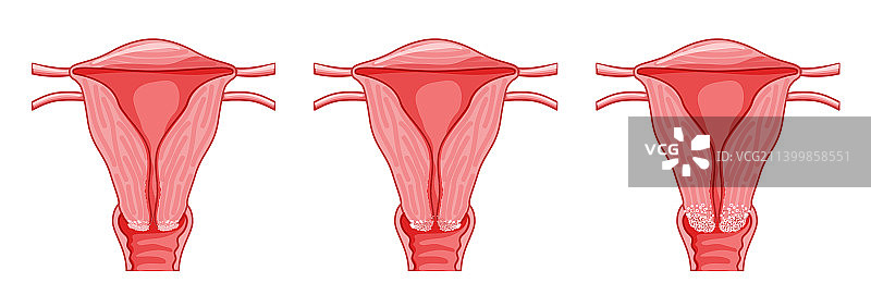 宫颈癌不典型增生阶段图片素材