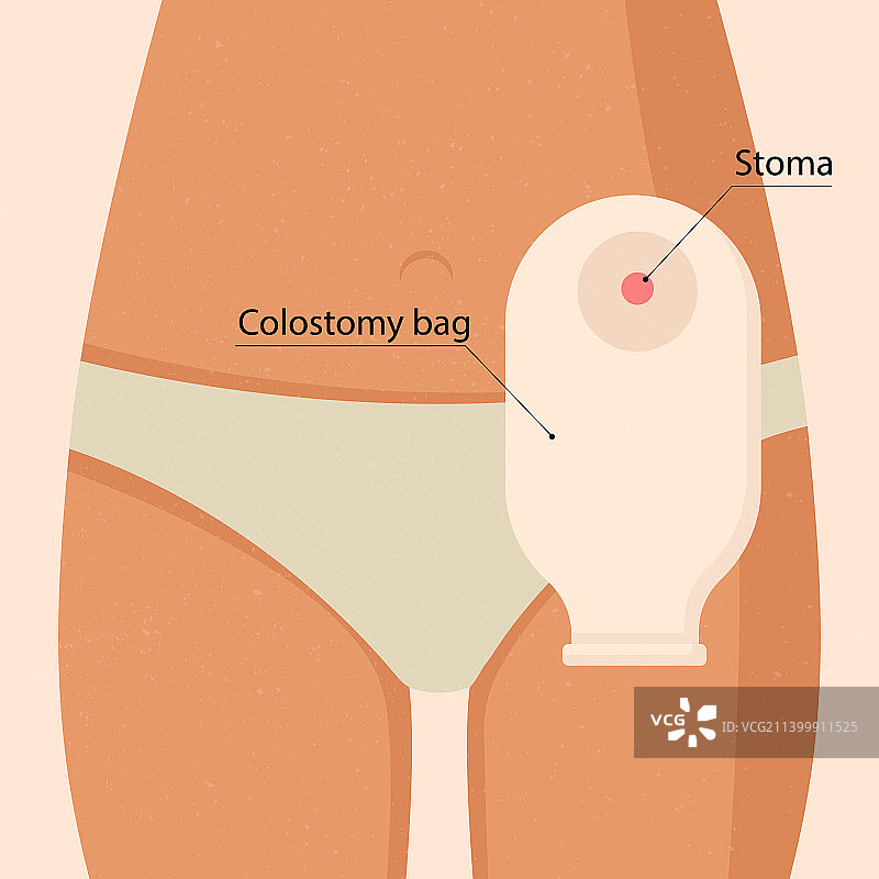 带着结肠造瘘袋的年轻女人图片素材