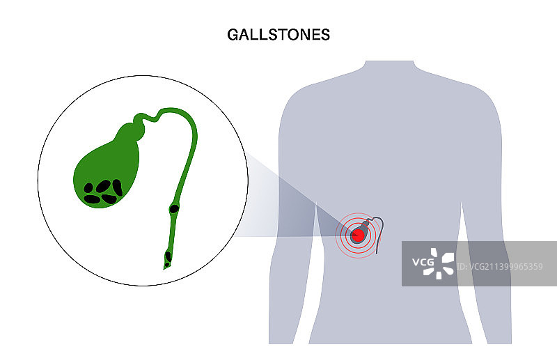 胆结石解剖图片素材