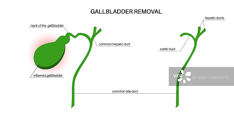胆囊切除手术图片素材