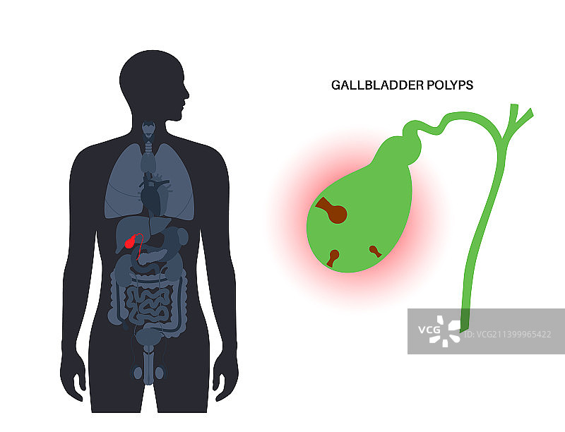 胆囊息肉解剖学图片素材