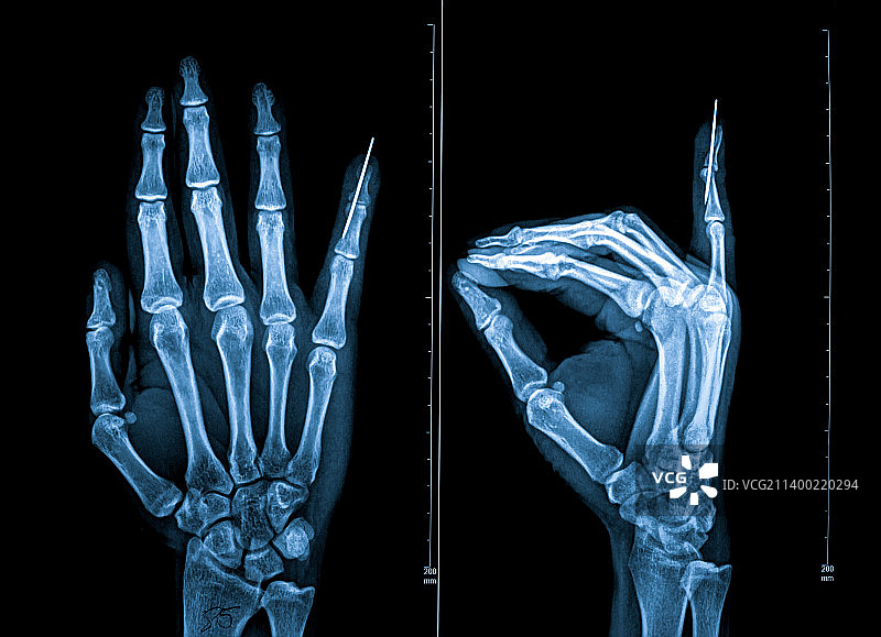 手指骨骼X光照片图片素材