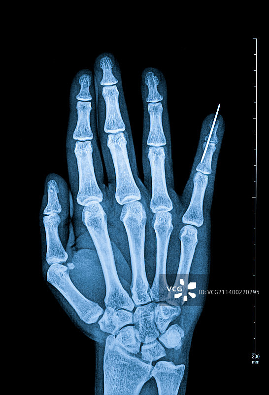 手指骨骼X光照片图片素材