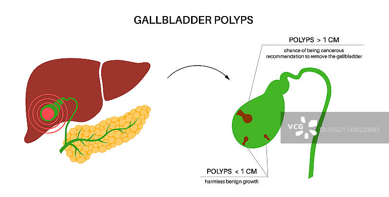胆囊息肉解剖图片素材