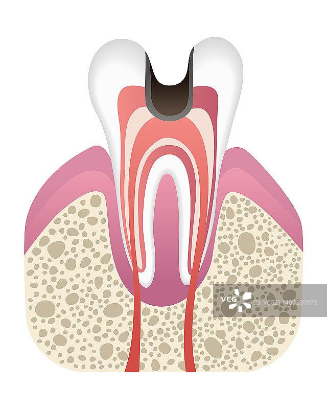 龋齿发展阶段牙齿结构图片素材