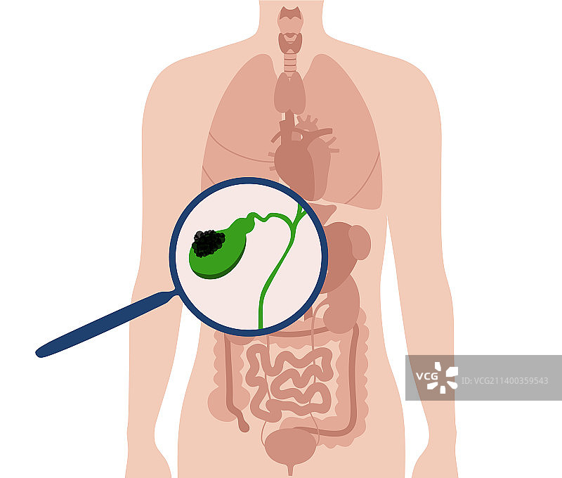 胆囊癌解剖图片素材