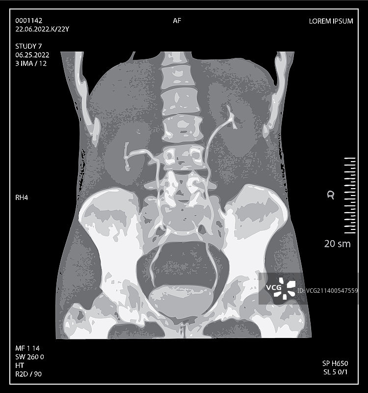 含骨盆和脊柱的人体腹部X光片图片素材