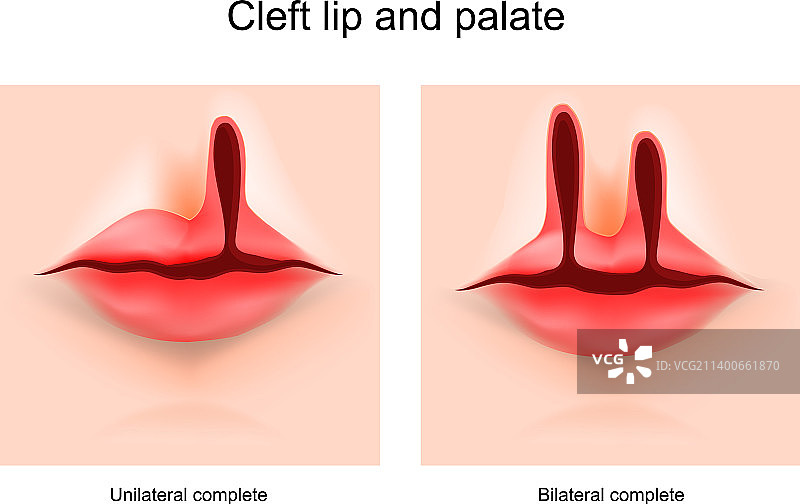 唇腭裂图片素材