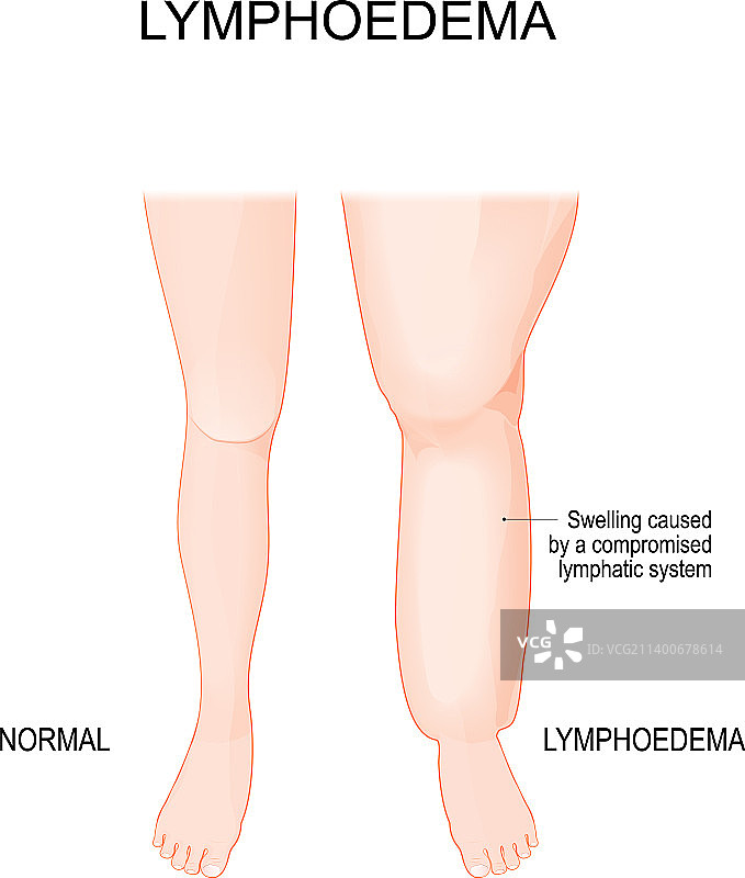 淋巴水肿下肢淋巴阻塞图片素材