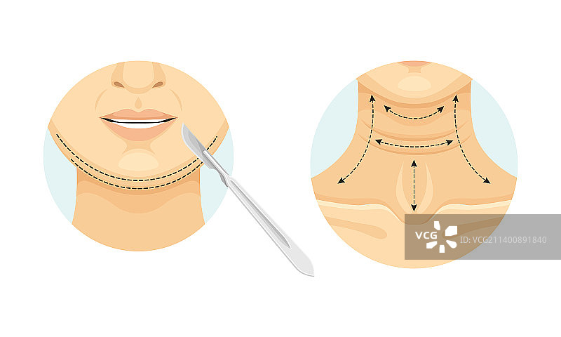 下巴和颈部点刺整形手术图片素材