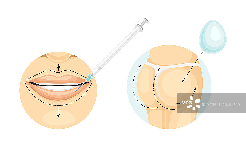 嘴唇和臀部整形手术图片素材