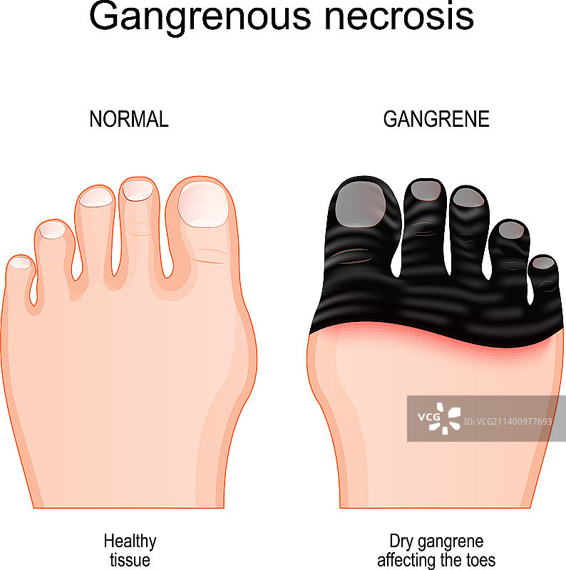 足趾坏疽组织死亡图片素材