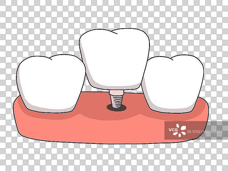 元素：种植牙图片素材
