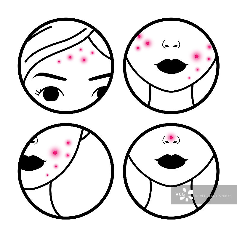 女性面部痤疮图片素材