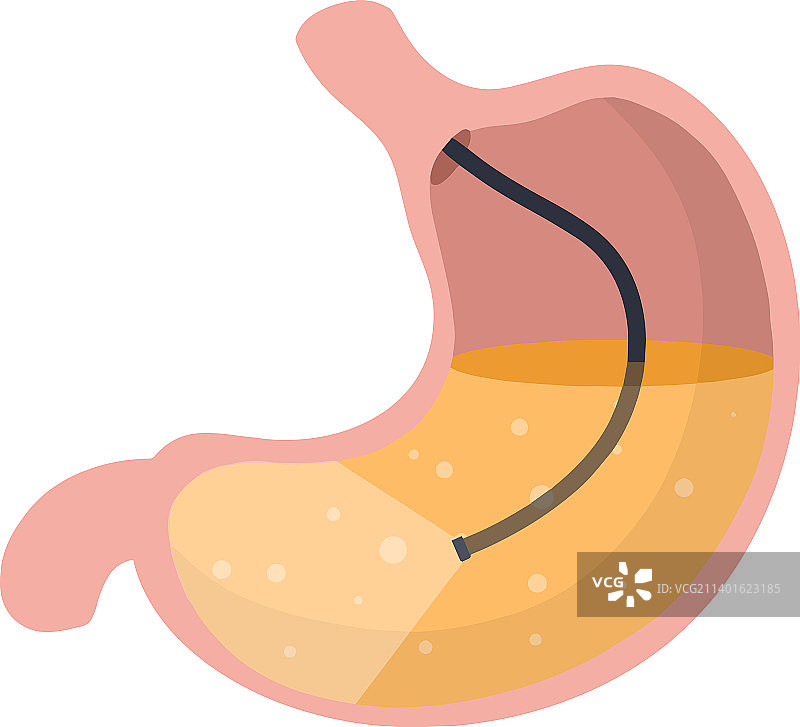 胃镜内窥镜与消化问题图片素材